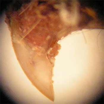 Foreign Body Analysis