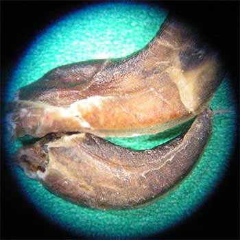 Foreign Body Analysis